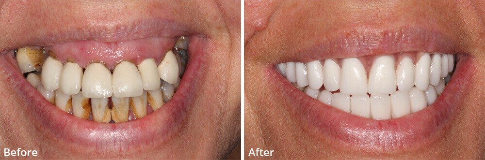 Bottom Dentures Gladstone NJ 7934